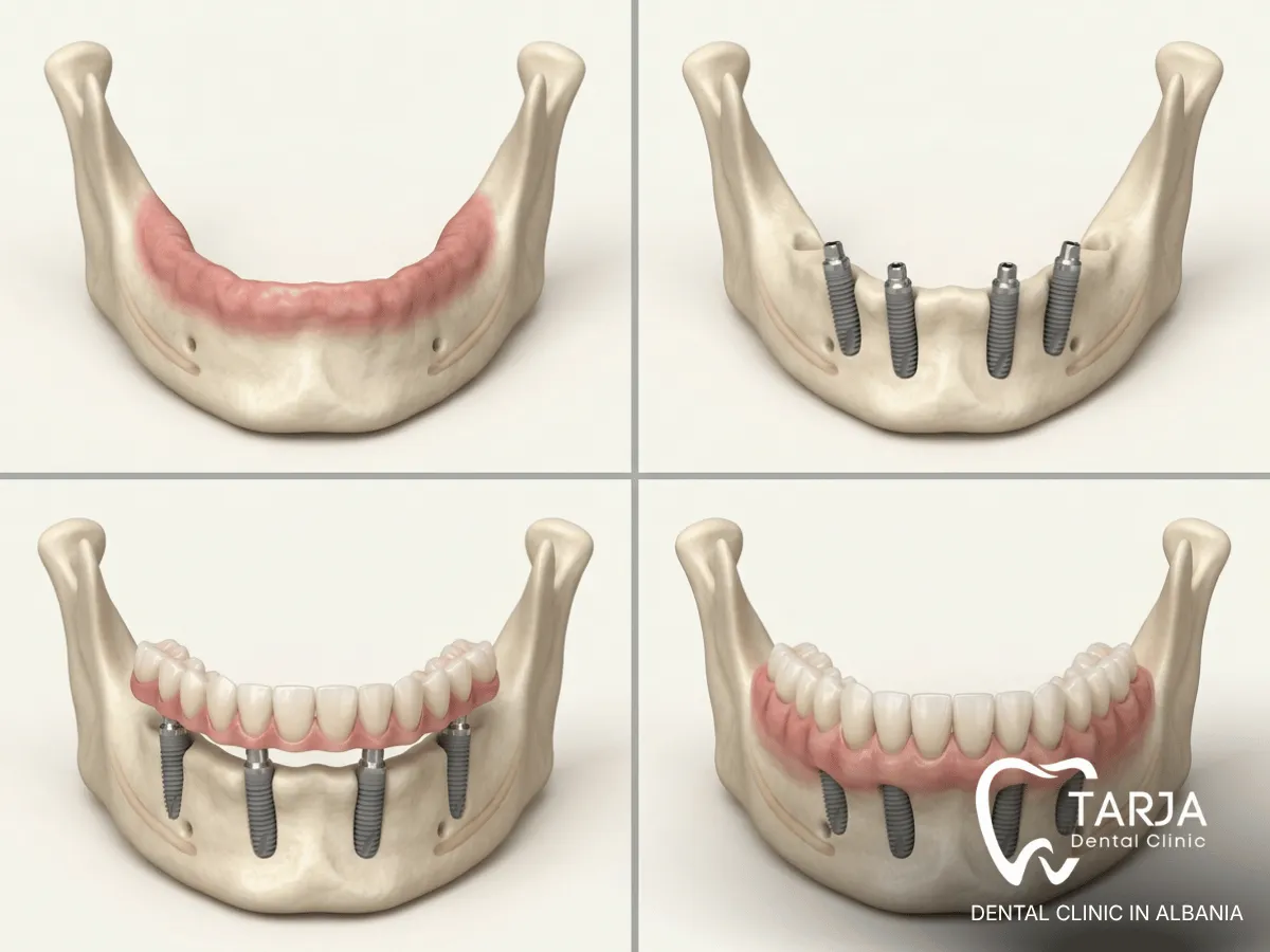 Full-arch dental implant treatment stages for patients traveling abroad