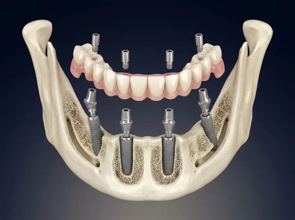 Illustration médicale 3D d’une prothèse provisoire fixe All-on-4 sur quatre implants mandibulaires