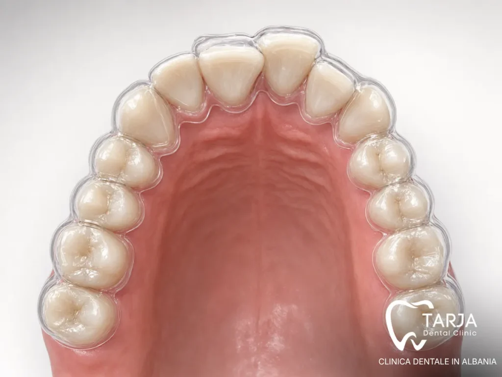 Mascherina trasparente applicata su denti affollati