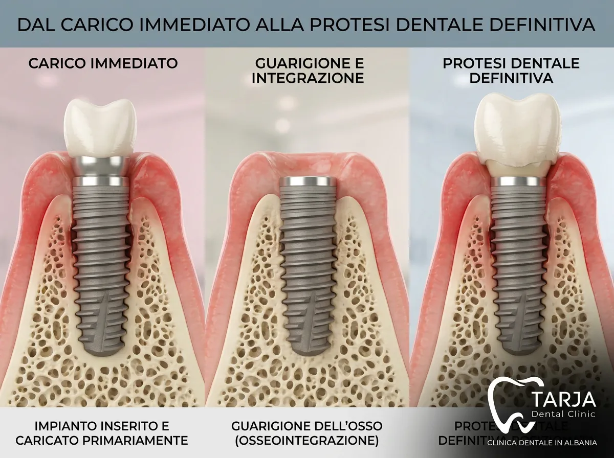 Osteointegrazione dell’impianto dentale dai denti provvisori a quelli definitivi