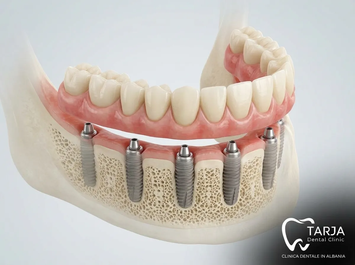 Protesi fissa provvisoria applicata subito dopo gli impianti dentali