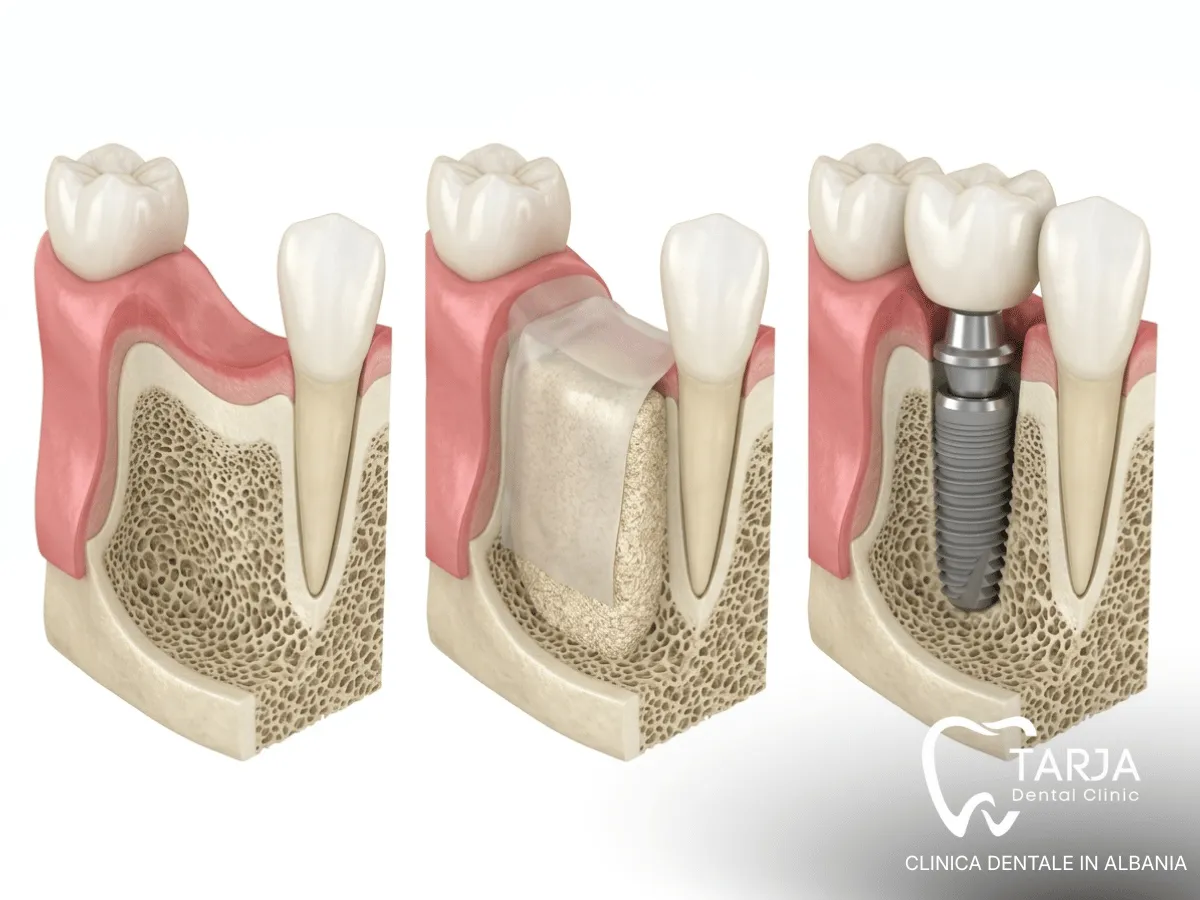 Rigenerazione ossea prima dell’inserimento di un impianto dentale per ottenere un dente fisso