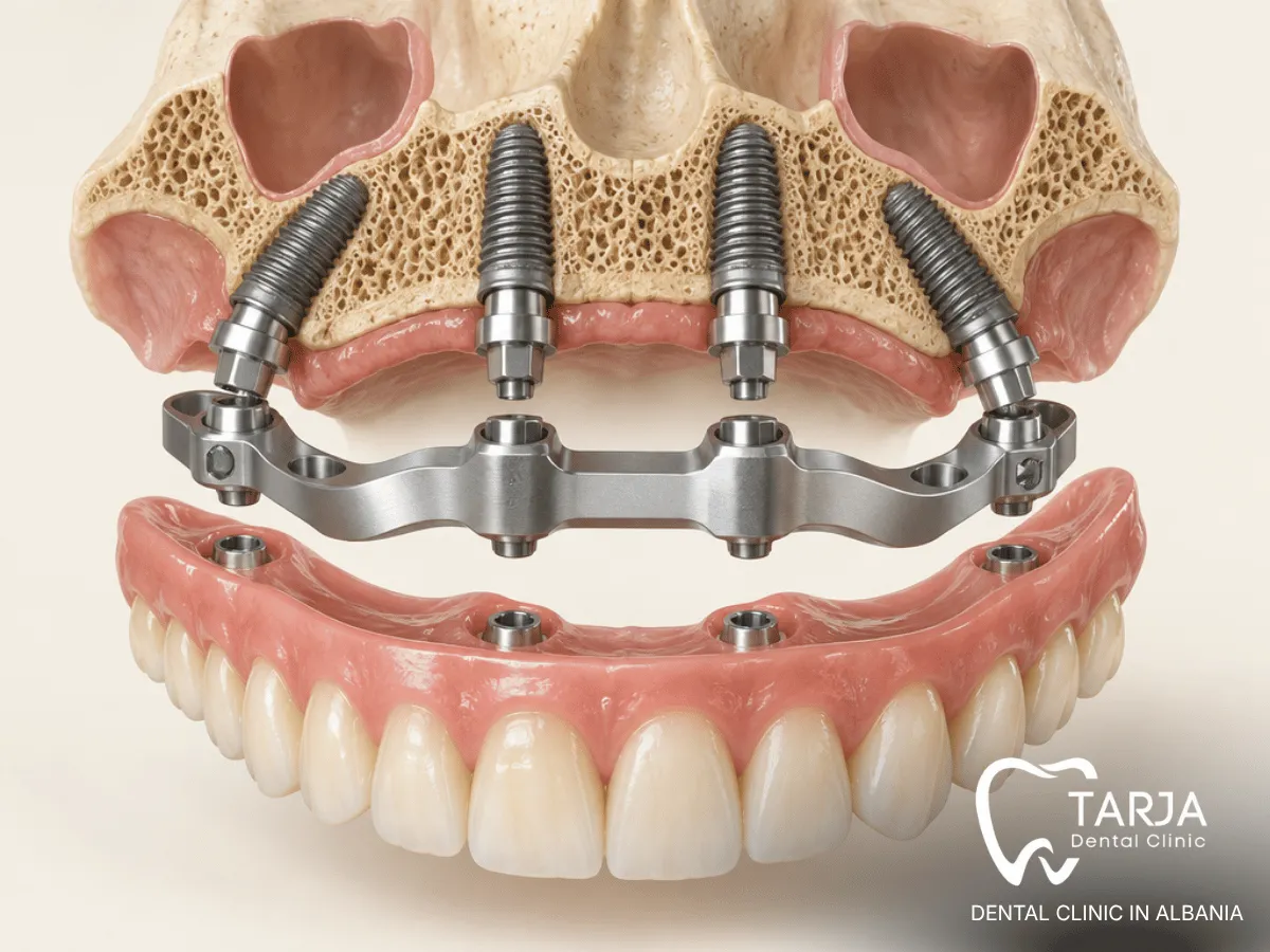 Acrylic PMMA All-on-4 teeth supported by a titanium framework