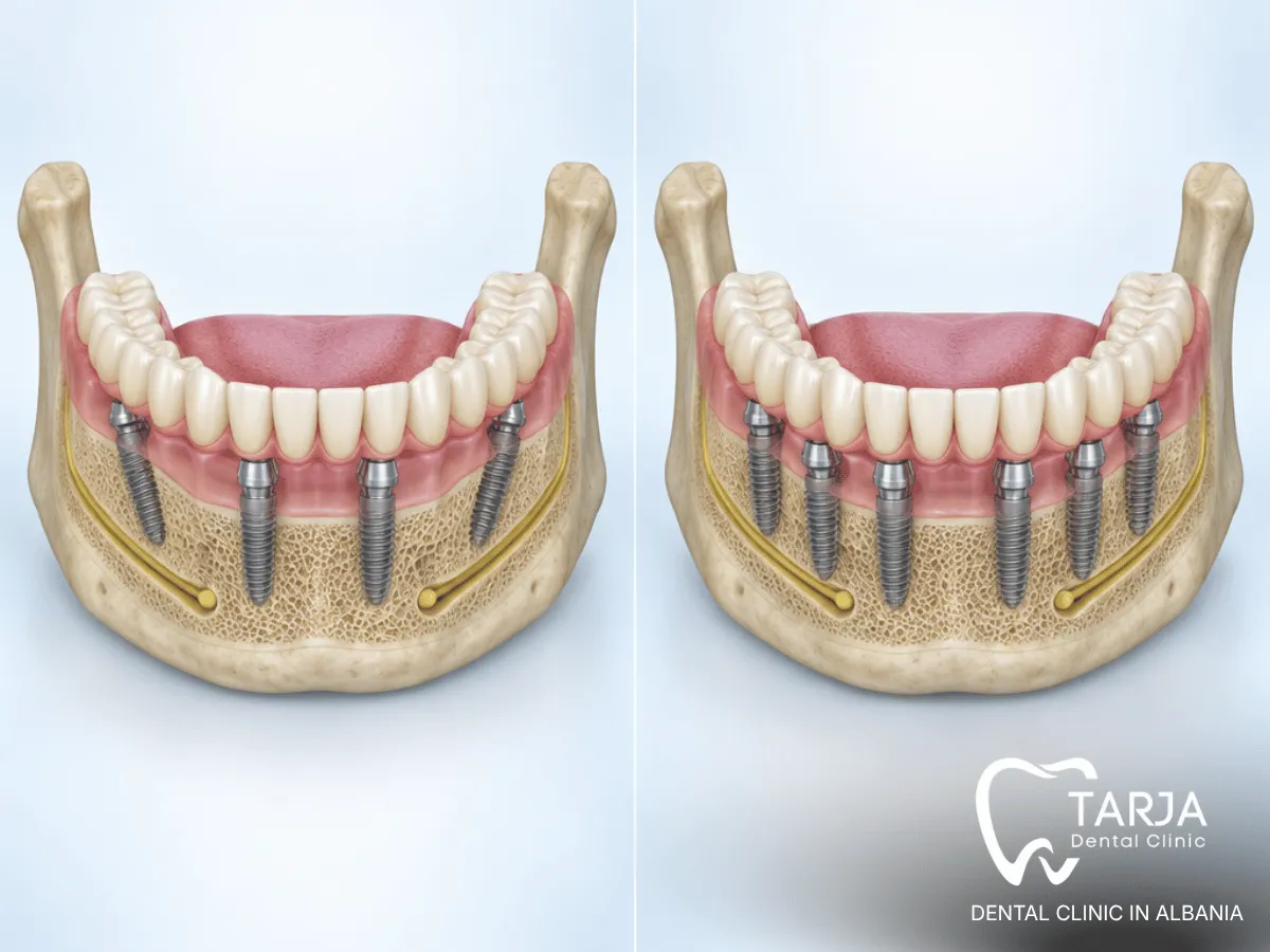 All-on-4 and All-on-6 full-arch dental implant configurations