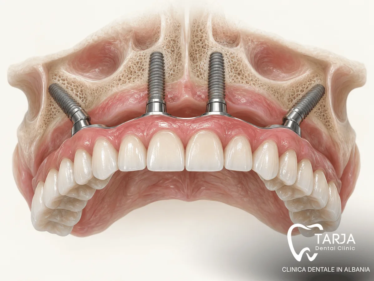 All-on-4 dental implants with four implants supporting a fixed full arch