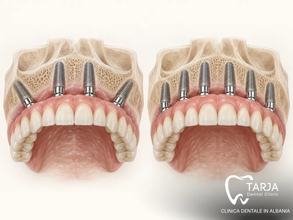 All on 4 vs All on 6 dental implants supporting a fixed full arch