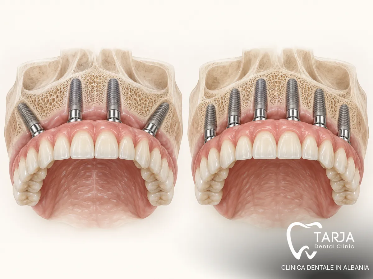 All-on-4 vs All-on-6 Dental Implants: Which Is Better for a Full Arch?