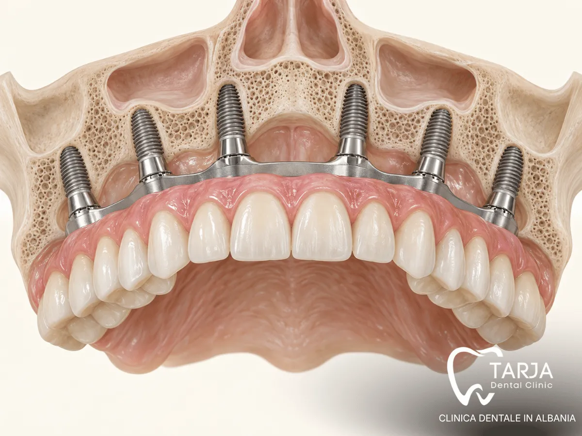All-on-6 dental implants with six implants supporting a fixed full arch
