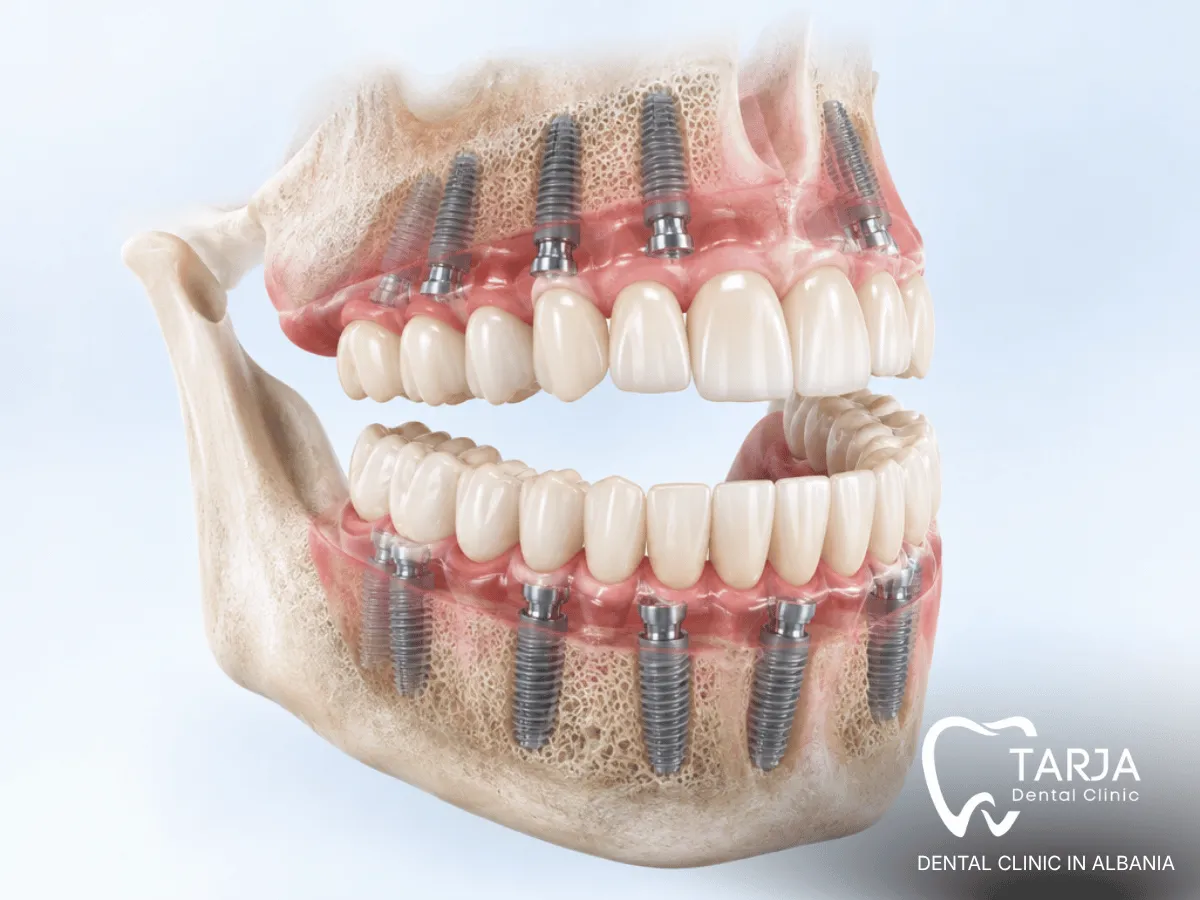 Am I a Candidate for Full-Mouth Dental Implants?