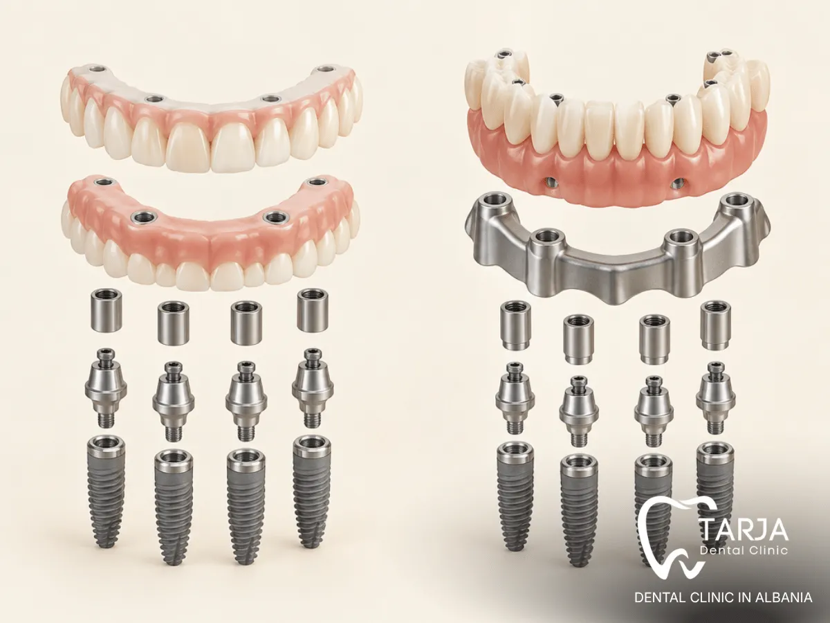 Material layers inside zirconia and acrylic full-arch implant bridges