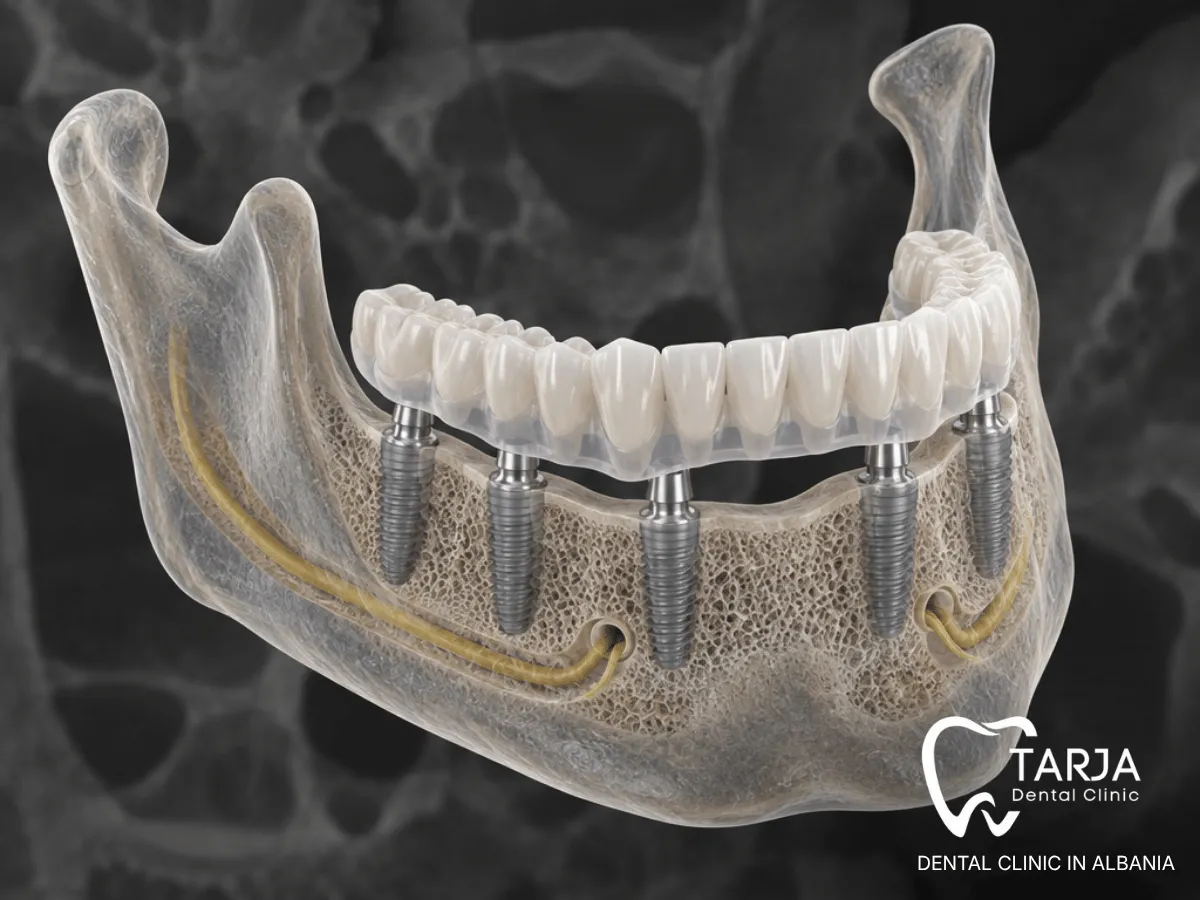3D planning of six implants for a fixed full-arch dental bridge