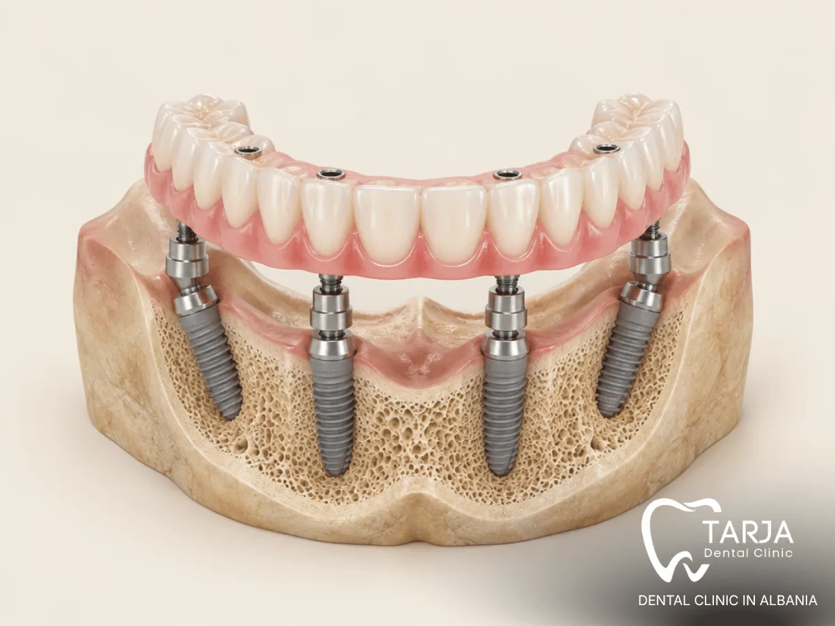Monolithic zirconia All-on-4 bridge connected to four dental implants