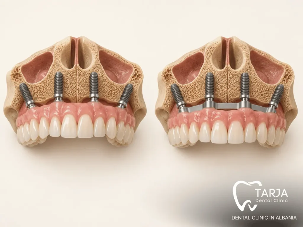 Zirconia vs acrylic All on 4 teeth for a fixed full-arch bridge