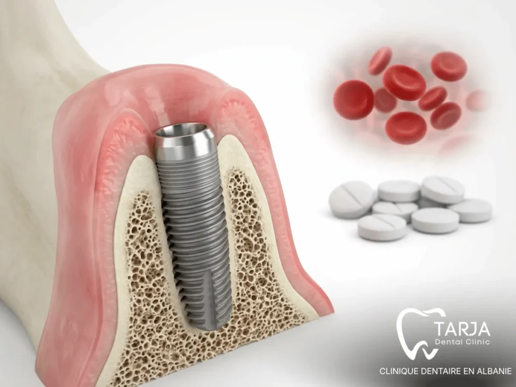 Anticoagulants et implant dentaire avec implant en titane dans l’os de la mâchoire