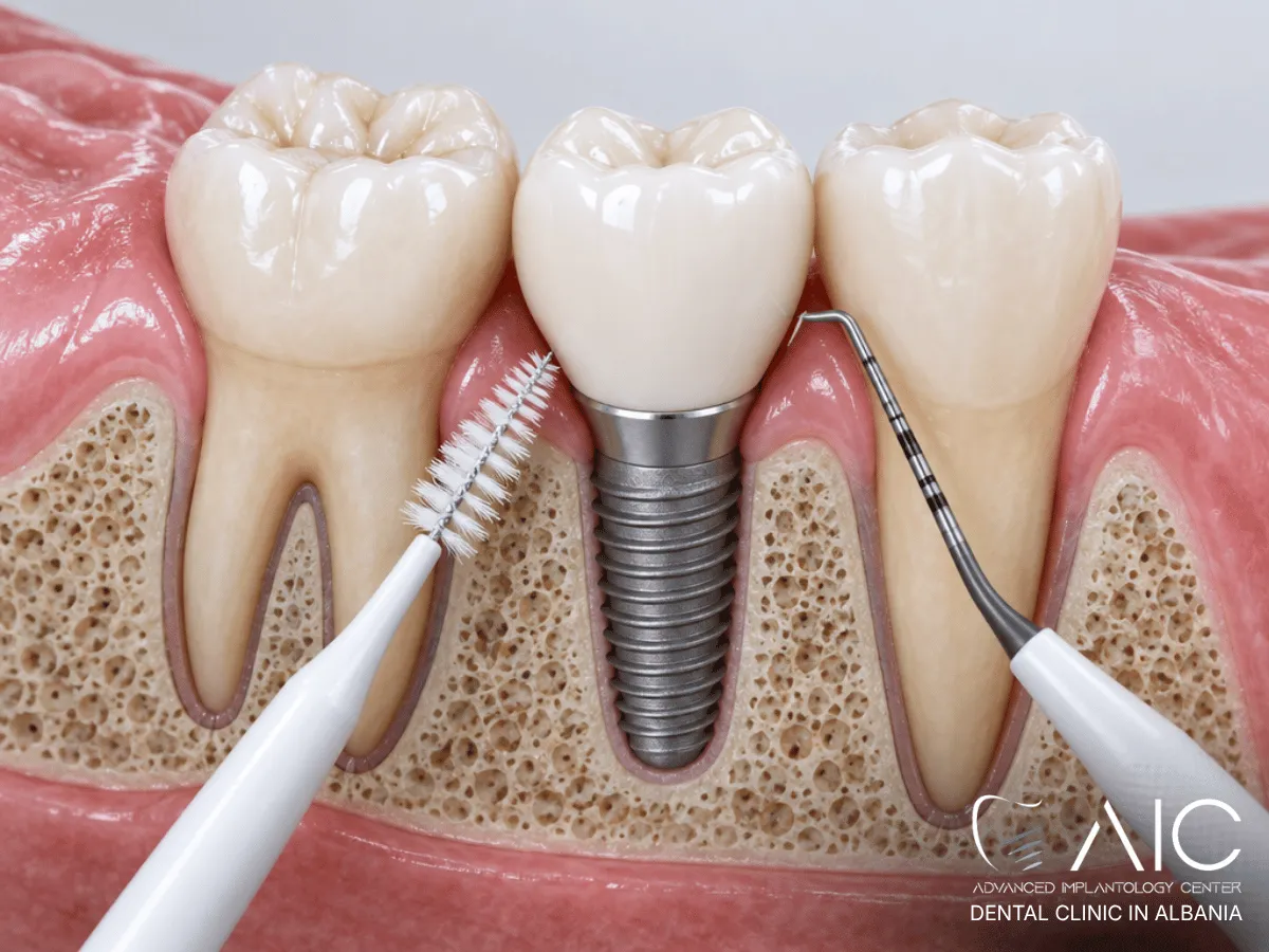 Implant dentaire et diabète : est-ce possible et quelles précautions prendre ?