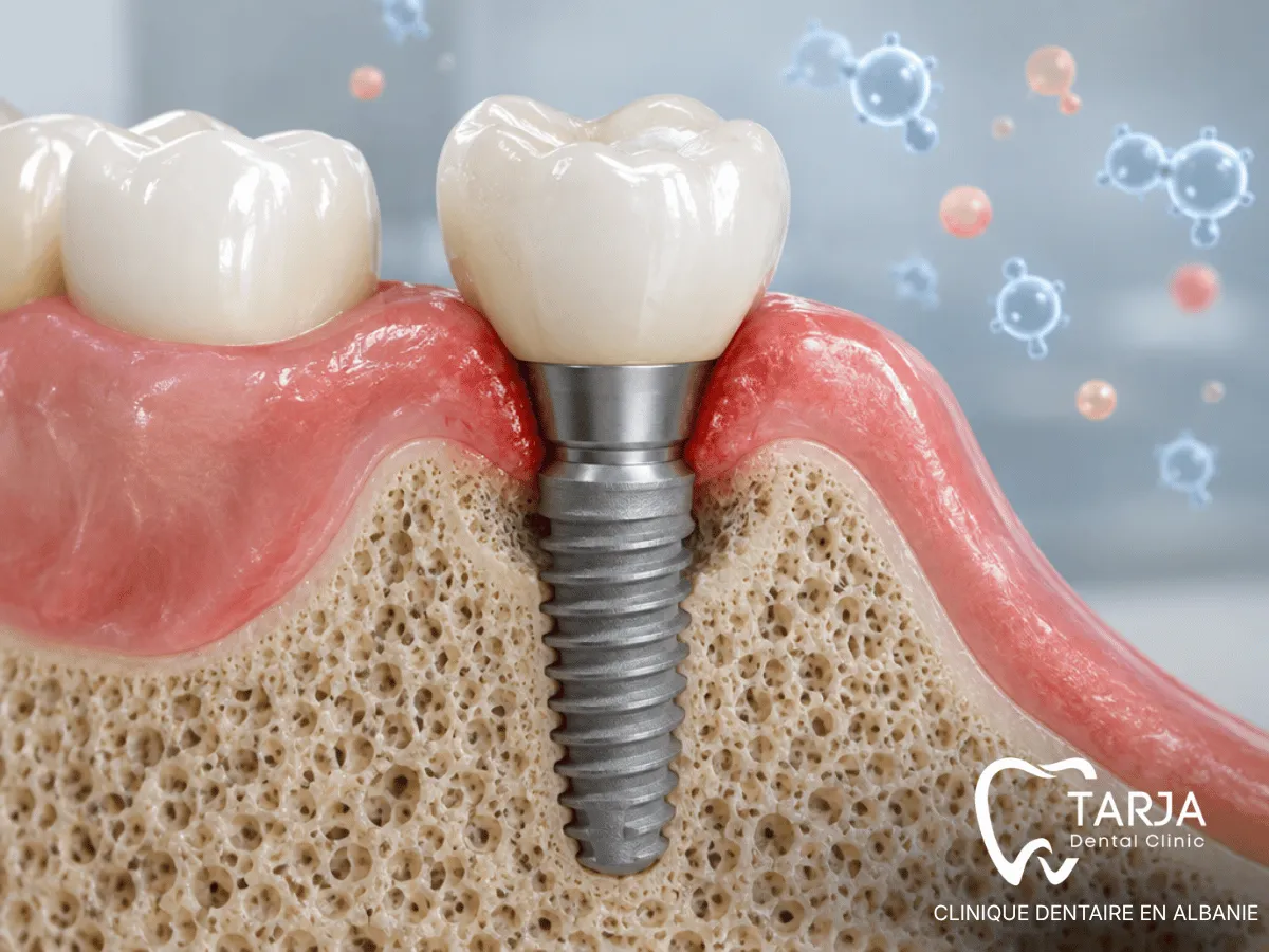 Diabète et inflammation péri-implantaire autour d’un implant dentaire
