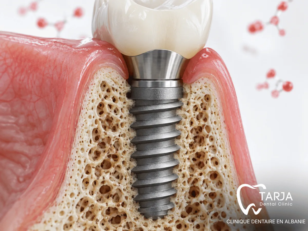 Diabète et ostéointégration autour d’un implant dentaire en titane