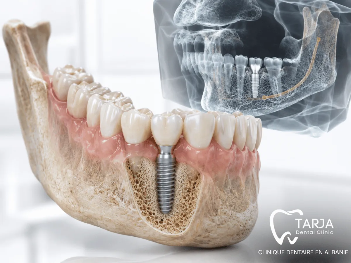 Évaluation avant implant dentaire chez un patient diabétique