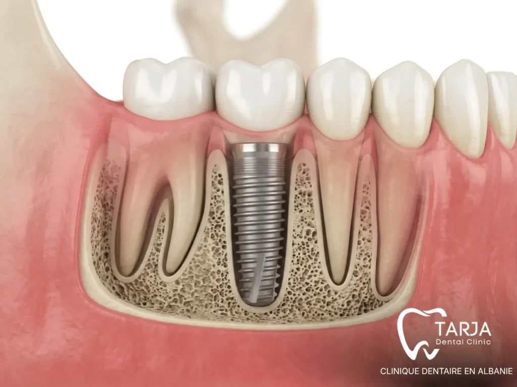 Implant dentaire après une parodontite avec implant en titane intégré dans l’os