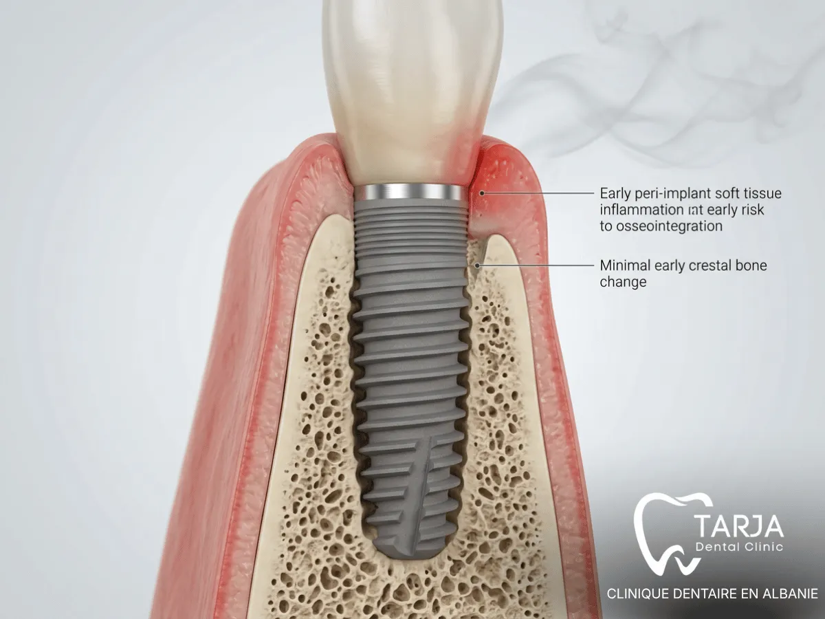 Tabac, ostéointégration et risque de péri-implantite autour d’un implant dentaire